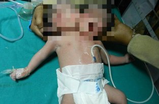 В Индии родился ребенок с двумя головами (3 фото) (жесть)