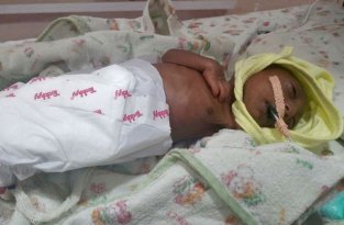 Двухнедельный младенец с редким заболеванием кожи (5 фото)