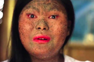 Из-за редкого заболевания кожа этой филиппинки стала похожа на змеиную чешую (4 фото + 1 видео)