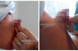 В Азербайджане родился мальчик с пенисом-паразитом на спине (4 фото)