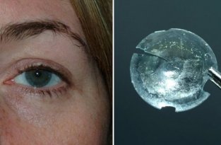Из века женщины достали контактную линзу, которая пробыла там почти 30 лет (3 фото)