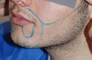 Пересадка волос в район бороды (4 фото)