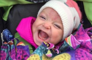 Малышка, родившаяся с огромным языком, наконец-то может улыбаться (8 фото)