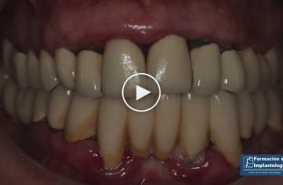 Имплантация зубов (жесть)