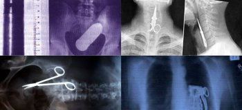 Удивительные рентгеновские снимки, способные шокировать врачей (12 фото)